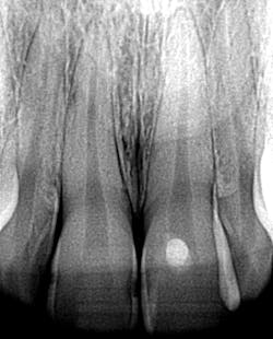 Figure 2: Class III caries Figure 2: Class III caries