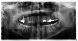 Figure 1: Radiograph taken six years prior to case presentation shows a radiopaque s-/oval-shaped lesion on the right side of the mandible just inferior to the apical roots of tooth no. 31.