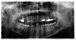 Figure 1: Radiograph taken six years prior to case presentation shows a radiopaque s-/oval-shaped lesion on the right side of the mandible just inferior to the apical roots of tooth no. 31. Figure 1: Radiograph taken six years prior to case presentation shows a radiopaque s-/oval-shaped lesion on the right side of the mandible just inferior to the apical roots of tooth no. 31.