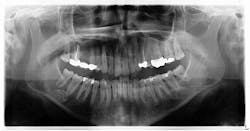 Figure 2: Six years later, at case presentation, the lesion on the lower right side of the mandible was still present with no significant changes in shape or size. Figure 2: Six years later, at case presentation, the lesion on the lower right side of the mandible was still present with no significant changes in shape or size.