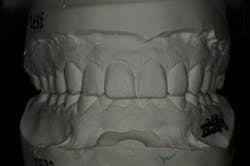 Figure 12: Analog wax-up Figure 12: Analog wax-up