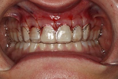 Figure 14: Gingival levels confirmed with the surgical stent after surgical crown lengthening