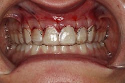 Figure 14: Gingival levels confirmed with the surgical stent after surgical crown lengthening Figure 14: Gingival levels confirmed with the surgical stent after surgical crown lengthening