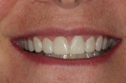 Figure 15: Provisional restorations on Nos. 5–12 Figure 15: Provisional restorations on Nos. 5–12