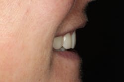 Figure 16: Provisional restorations on Nos. 5–12 Figure 16: Provisional restorations on Nos. 5–12