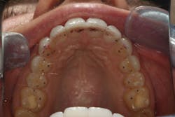 Figure 19: Occlusal view showing “lines in the front, dots on the back” technique Figure 19: Occlusal view showing “lines in the front, dots on the back” technique