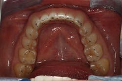 Figure 20: Occlusal view showing “lines in the front, dots on the back” technique Figure 20: Occlusal view showing “lines in the front, dots on the back” technique