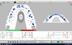 Figure 21: Occlusion checked with T-Scan (Tekscan Inc.) Figure 21: Occlusion checked with T-Scan (Tekscan Inc.)