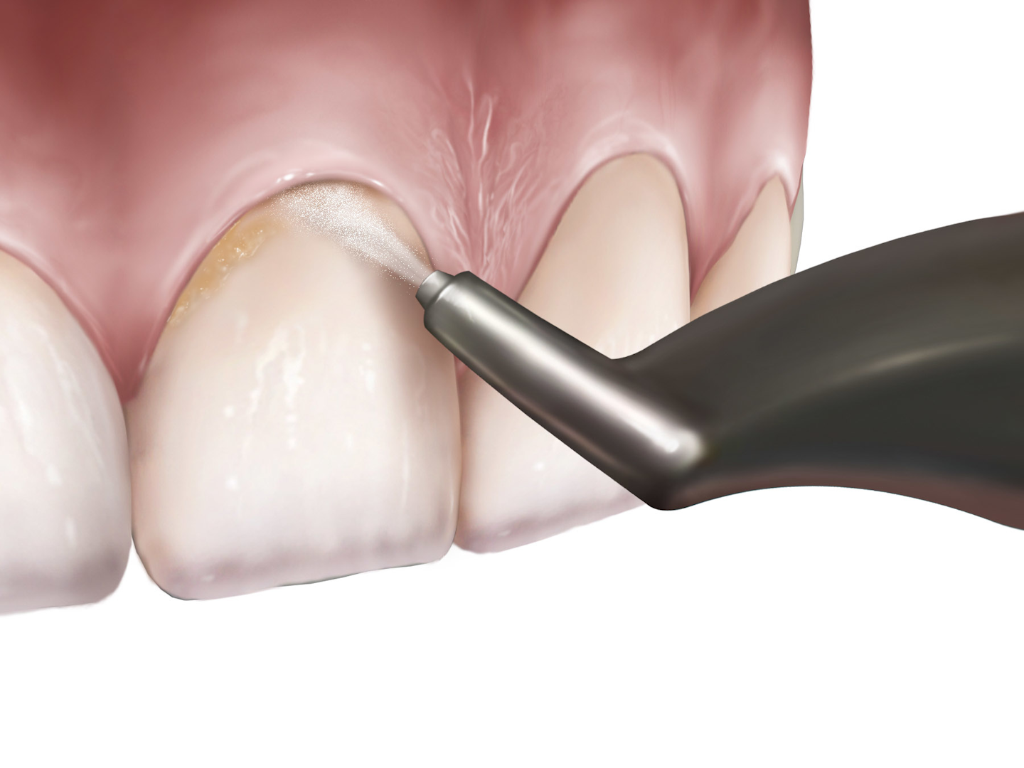 АИР флоу в стоматологии