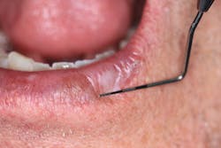 Figure 1: Leukoplakic lesion on lower left lip Figure 1: Leukoplakic lesion on lower left lip
