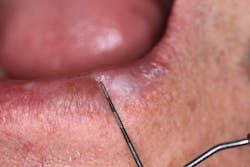 Figure 2: 6 mm x 9 mm irregular-shaped lesion appears white Figure 2: 6 mm x 9 mm irregular-shaped lesion appears white