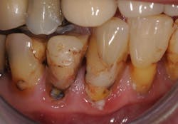 Figure 1: Extensive root caries can lead to repeated restorations that are doomed to fail unless the status of the mouth changes. Figure 1: Extensive root caries can lead to repeated restorations that are doomed to fail unless the status of the mouth changes.