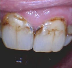 Figure 1: Gross, rampant caries Figure 1: Gross, rampant caries