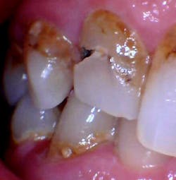 Figure 2: Gross, rampant caries Figure 2: Gross, rampant caries