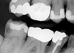 Figure 3: Radiograph of gross, rampant caries Figure 3: Radiograph of gross, rampant caries
