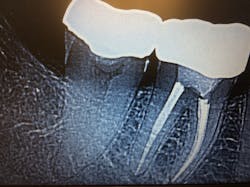 Figure 1: Open mesial margin on No. 31 Figure 1: Open mesial margin on No. 31