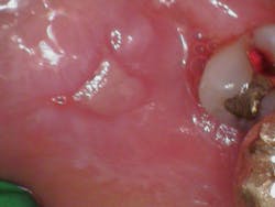 Figure 1: Ulcerated intraoral lesions