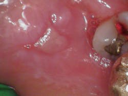 Figure 1: Ulcerated intraoral lesions Figure 1: Ulcerated intraoral lesions