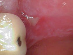 Figure 2: Ulcerated intraoral lesions