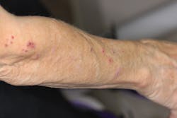 Figure 3: Arm lesions, appearing to be in the healing stage Figure 3: Arm lesions, appearing to be in the healing stage