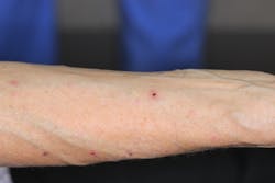 Figure 4: Arm lesions, appearing to be in the healing stage Figure 4: Arm lesions, appearing to be in the healing stage