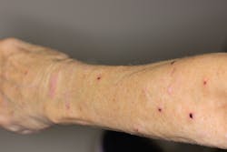 Figure 5: Arm lesions, appearing to be in the healing stage