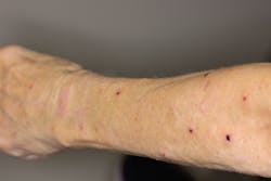 Figure 5: Arm lesions, appearing to be in the healing stage Figure 5: Arm lesions, appearing to be in the healing stage