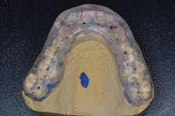 Figure 1: Flat-plane occlusal splint Figure 1: Flat-plane occlusal splint