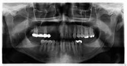 Figure 1: Radiograph postaccident Figure 1: Radiograph postaccident