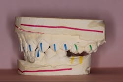Figure 2: Models depicting supereruption of nos. 14 and 15 Figure 2: Models depicting supereruption of nos. 14 and 15
