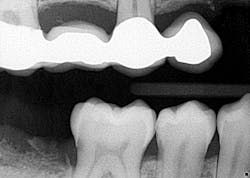 Figure 3: Radiograph postaccident Figure 3: Radiograph postaccident
