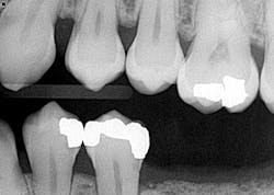Figure 4: Radiograph postaccident Figure 4: Radiograph postaccident