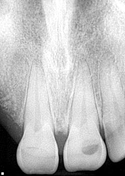 Figure 5: Radiograph postaccident Figure 5: Radiograph postaccident