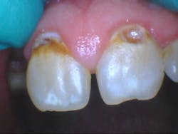 Figure 6: Clinical caries Figure 6: Clinical caries