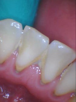 Figure 7: Tartar buildup Figure 7: Tartar buildup