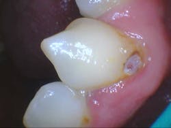Figure 8: Clinical caries Figure 8: Clinical caries