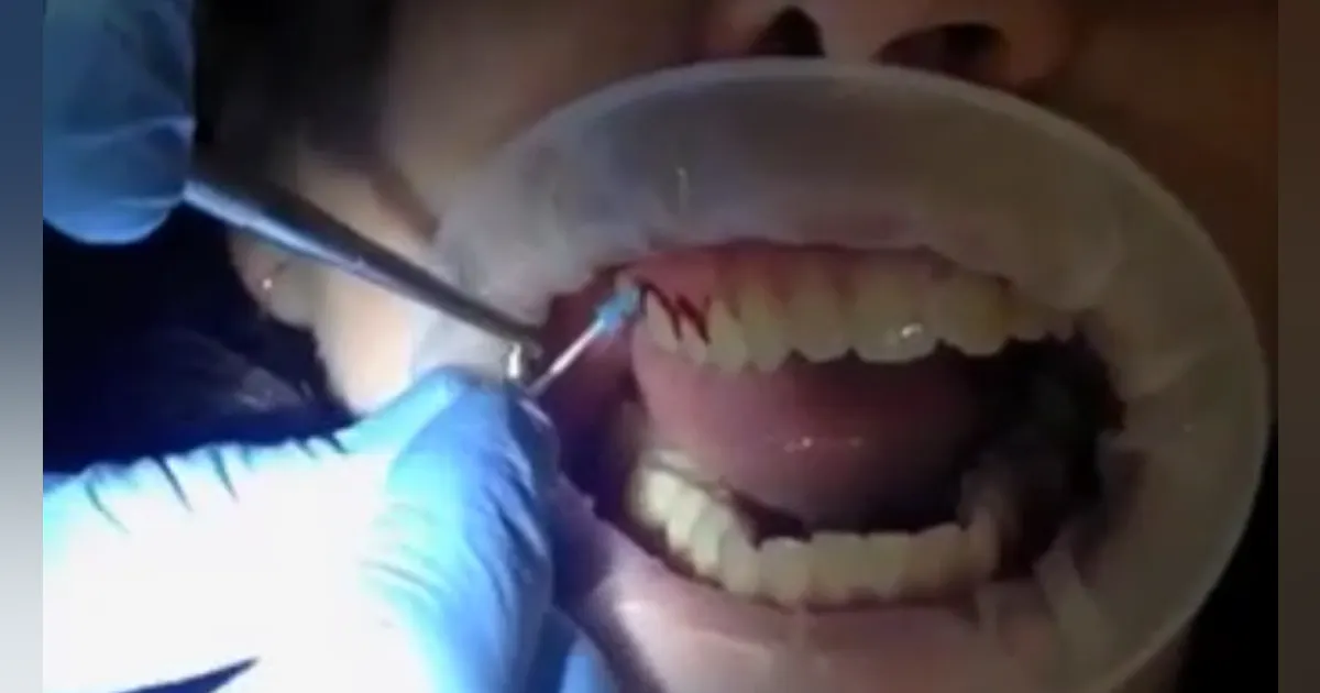 Fell Sulcular Sweep: A better way to control gum disease and decay and cover floss’s shortcomings Fell Sulcular Sweep: A better way to control gum disease and decay and cover floss’s shortcomings