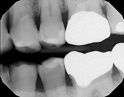 Figure 1: Flat tabletopped surfaces with noted radiolucencies due to wear facets Figure 1: Flat tabletopped surfaces with noted radiolucencies due to wear facets