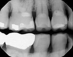 Figure 2: Flat tabletopped surfaces with noted radiolucencies due to wear facets Figure 2: Flat tabletopped surfaces with noted radiolucencies due to wear facets