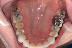 Figure 3: Posterior wear facets and generalized worn natural dentition Figure 3: Posterior wear facets and generalized worn natural dentition