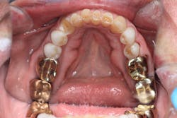 Figure 4: Posterior wear facets and generalized worn natural dentition Figure 4: Posterior wear facets and generalized worn natural dentition