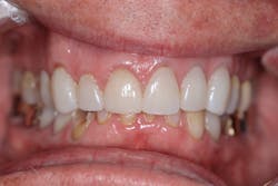 Figure 5: Deep bite noted facially and from the buccal aspect