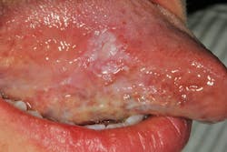 Figure 1: Case presentation&mdash;15 mm x 15 mm leukoplakic lesion on right lateral border of the tongue