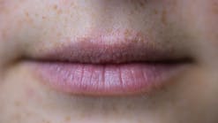 Lips before treatment (All photos courtesy of Vermillion Cosmetics)