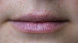 Lips before treatment (All photos courtesy of Vermillion Cosmetics)