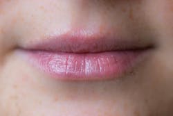 After vermattified lip serum treatment After vermattified lip serum treatment