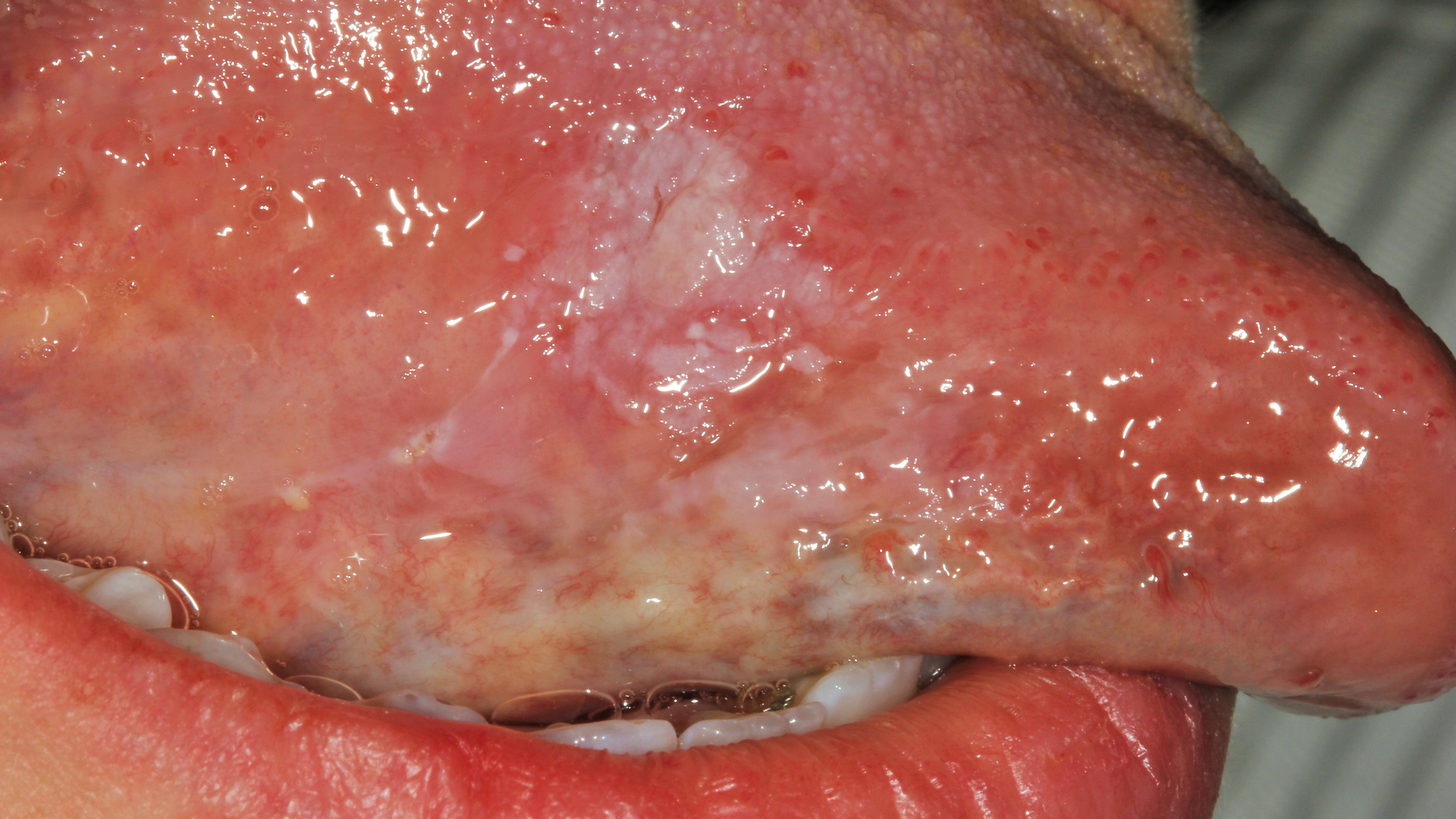 Figure 1: 15 mm x 15 mm leukoplakic lesion on right lateral border of the tongue&mdash;oral squamous cell carcinoma