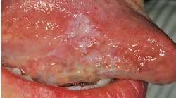 Figure 1: 15 mm x 15 mm leukoplakic lesion on right lateral border of the tongue&mdash;oral squamous cell carcinoma