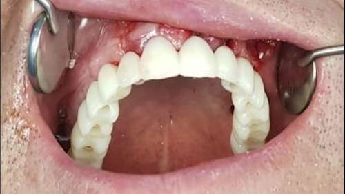 Full Mouth Dental Implants - Dentist - Fort Worth, Texas