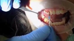 A screenshot from &apos;A better way to control gum disease and decay - Demonstration, part 1&apos; showing the amount of bleeding experienced by a patient who was already brushing and flossing